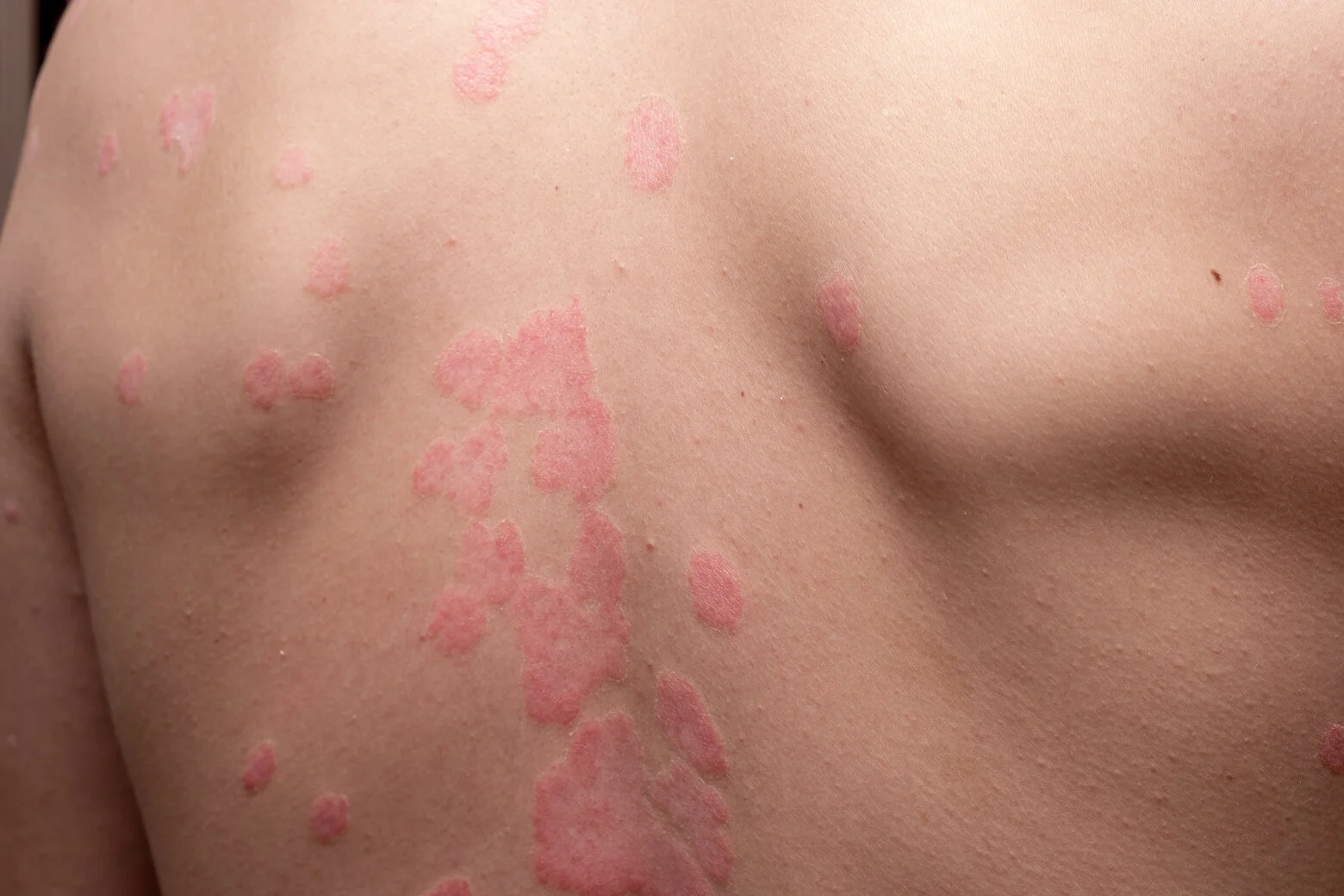 Psoriasis